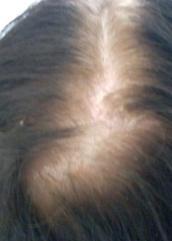 femalehairthinning