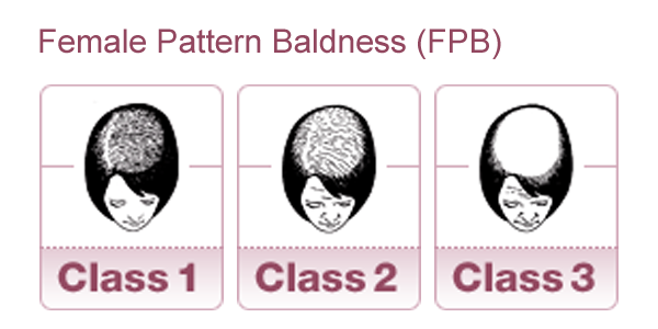 femalepatternbaldness