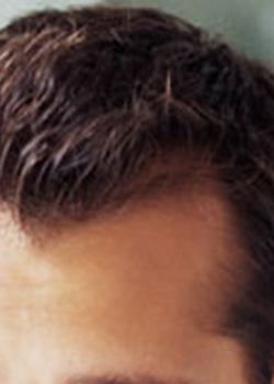male-hair-loss-sides