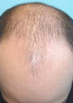 ukmalehairloss