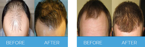 Before and after Fue hair transplant