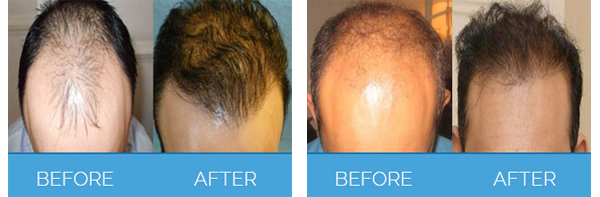 PRP Therapy in Manchester for Men and Women | Hair Loss Solutions