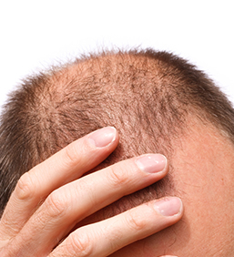 Ways to recover from Baldness